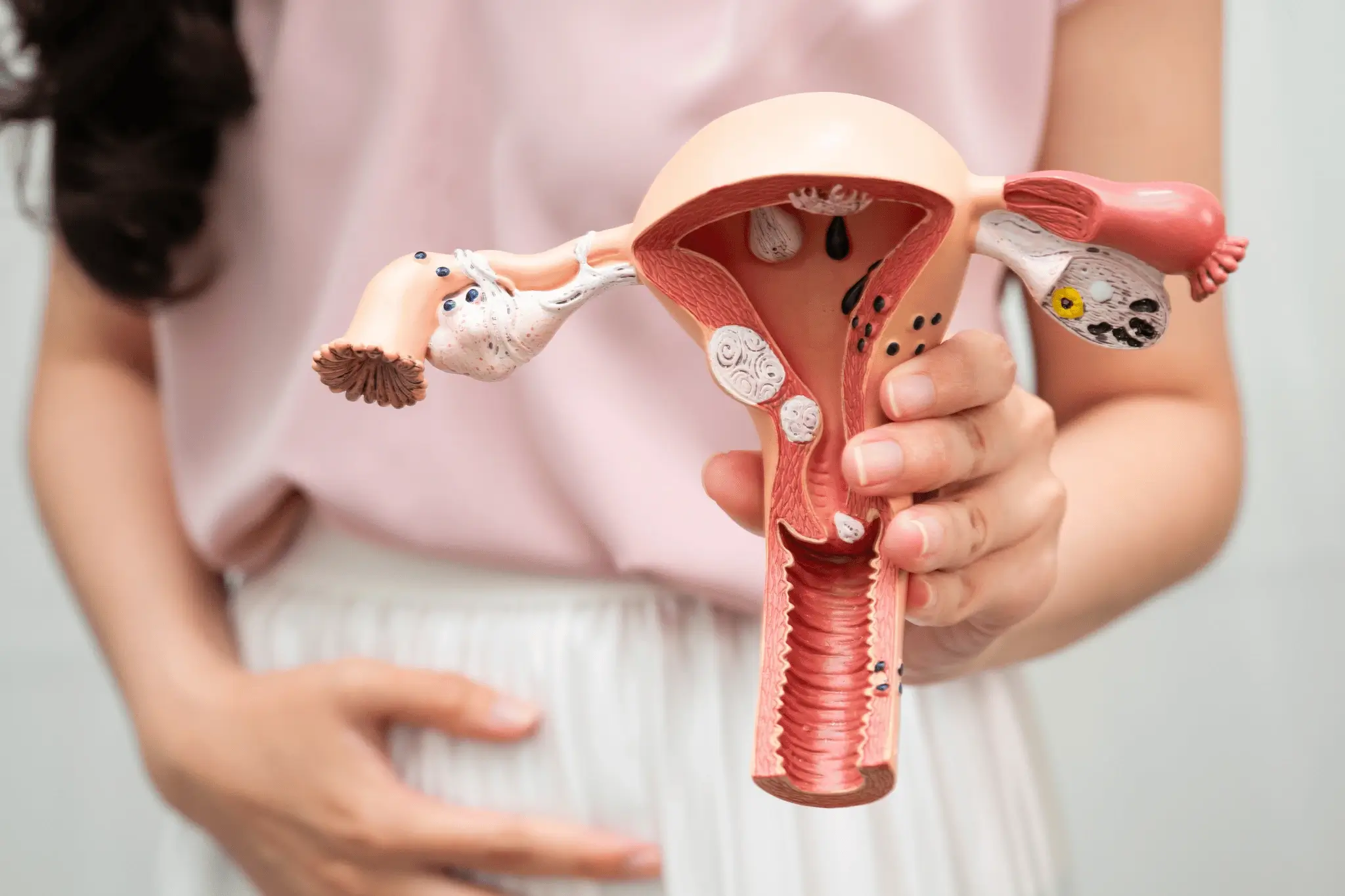 What are uterine polyps