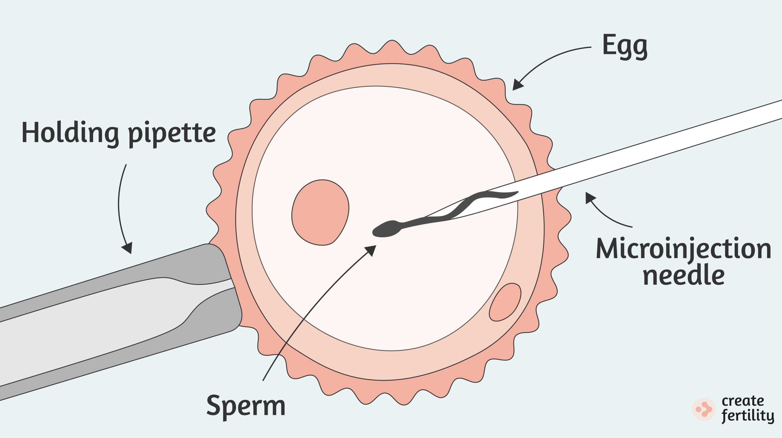 The ICSI procedure explained
